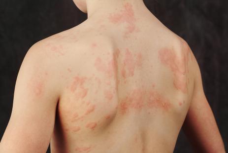 L’urticaire chronique spontanée est caractérisée par la survenue de crises dont l’apparition et la durée sont imprévisibles