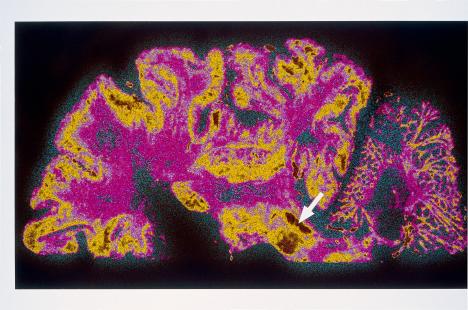 Le nouveau dispositif transdermique est indiqué à tous les stades de la maladie