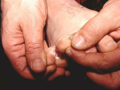 Le pied d’athlète peut être traité par la terbinafine