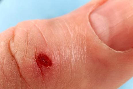 Une amélioration dans le traitement des cicatrices