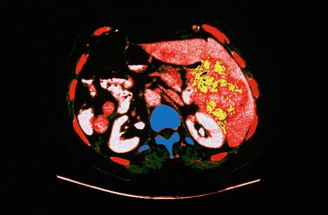 Le cancer hépatocellulaire est la plus redoutable des complications




cancerologie