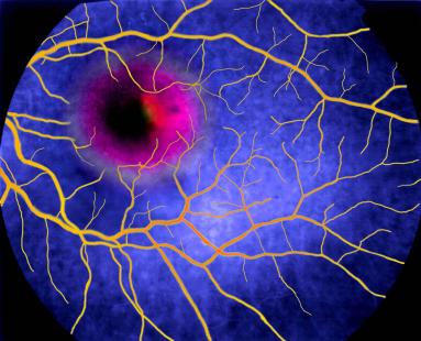 Une amélioration et une bonne tolérance ont été constatées
