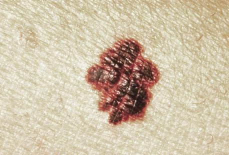 Des mélanomes exprimant l’antigène NY-ESO-1