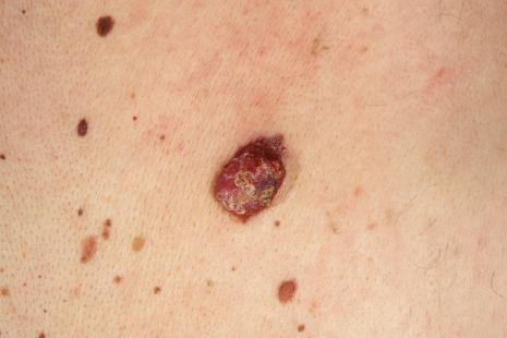 Un bénéfice clinique objectivé sur le mélanome