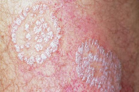 Le dépistage du psoriasis est relativement aisé