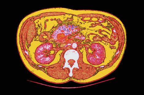 Cancer du pancreasScannercancerologie
