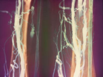 Thrombose veineuse profondeà l’angiographie