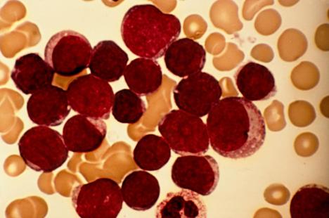 Environ 1 000 nouveaux cas de LAL sont diagnostiqués chaque année en France