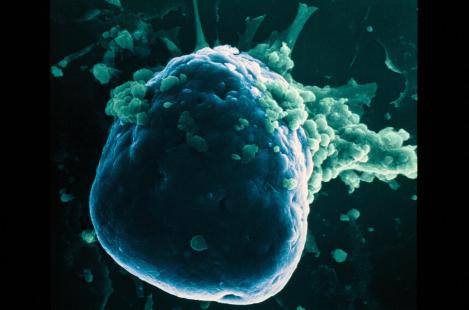 La greffe d’îlots de Langerhans permet de stabiliser le diabète