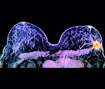 Le test oncotype est proposé à un stade précoce aux états-Unis