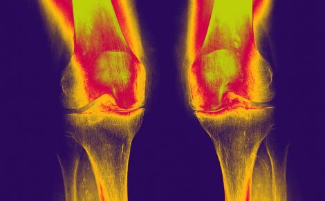 Arthrose