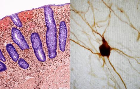 crohn parkinson