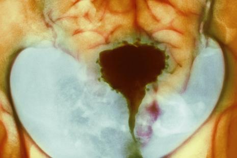 endométriose