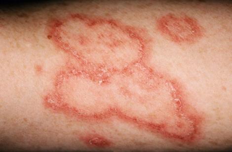 LUPUS