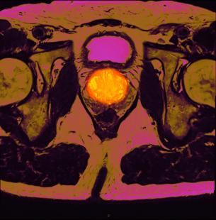 cancer prostate