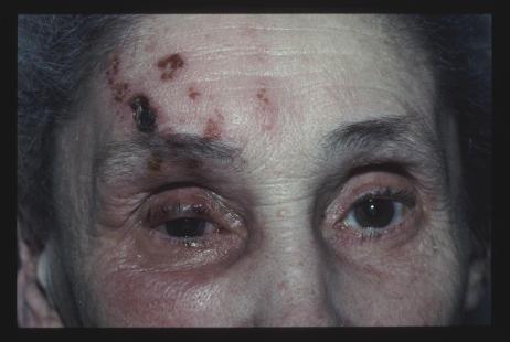 Zona ophtalmique nécrotique