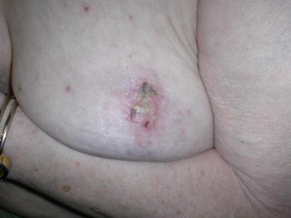 Bulle nécrotique du zona du sein