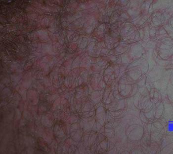 Papules rosées