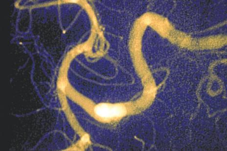 Accident vasculaire cerebral





avc neurologie hemoragie