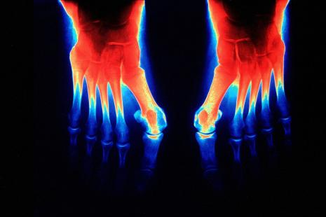 L’hallux valgus est la plus répandue des déformations du pied