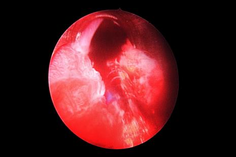 Fibroscopie de la prostate montrant une hypertrophie bŽnigne de la prostate lors du traitement...