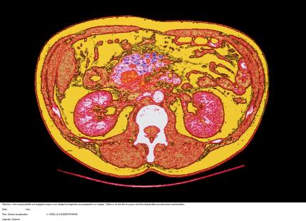 Le scanner et la biopsie signent le diagnostic