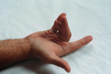 Actuellement, le traitement standard de la maladie Dupuytren est chirurgical