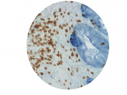 Les lymphocytes T (marron) prédisent la survie des patients. La tumeur est marquée en bleu