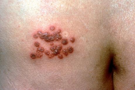 Le zona est la conséquence de la réactivation du virus zona varicelle