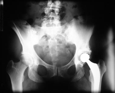 Prothèse totale de hanche