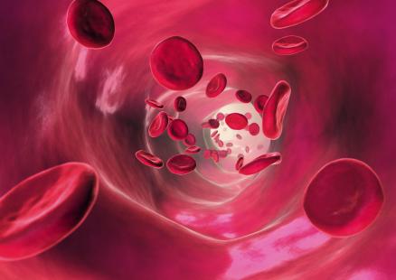 La prévention de la maladie thromboembolique veineuse progresse