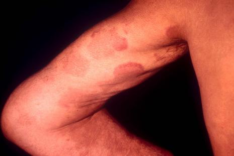 L’archétype de la maladie auto-immune non spécifique d’organe