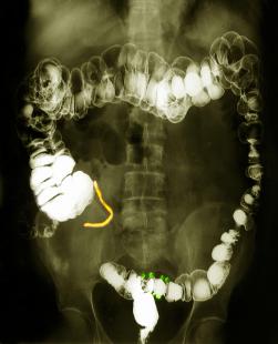 Les MICI sont souvent diagnostiquées avant l’âge de 30 ans